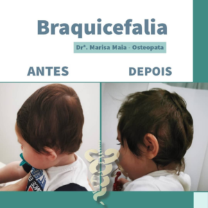 Read more about the article Braquicefalia