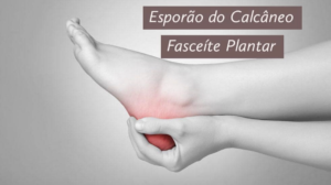 Read more about the article Fasceíte Plantar Esporão do Calcâneo